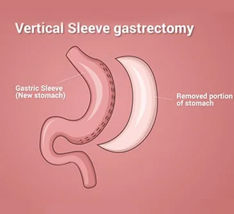 Metabolic Surgery Abu Dhabi