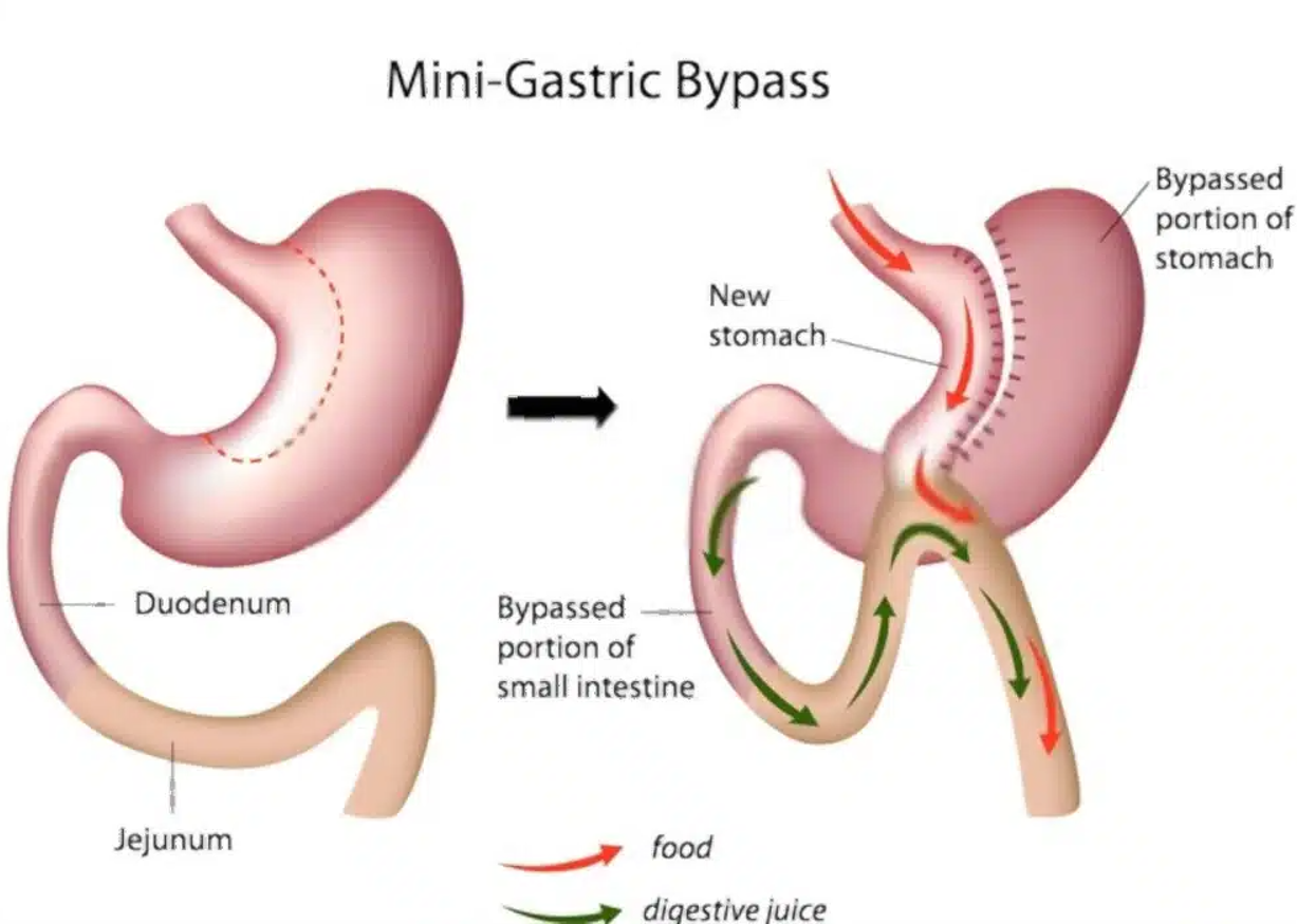 Mini Gastric Bypass Abu Dhabi