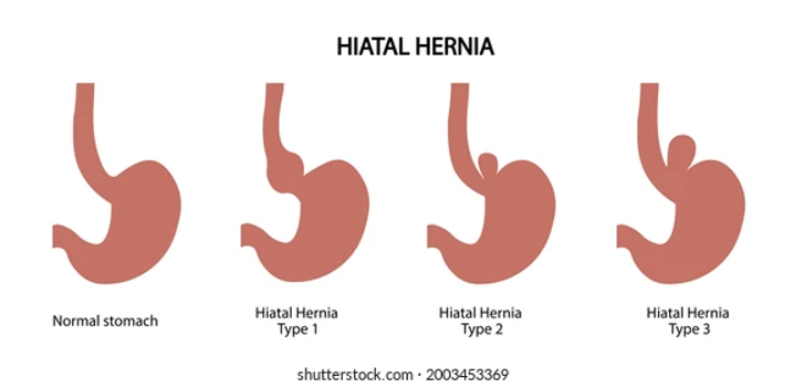 Hiatus Hernia Abu Dhabi